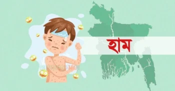 হাম উপসর্গে একদিনে আরও ৬ শিশুর মৃত্যু
