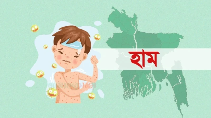 হাম উপসর্গে একদিনে আরও ৬ শিশুর মৃত্যু